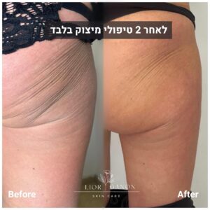 לפני-אחרי-מיצוק-הגוף.jpg